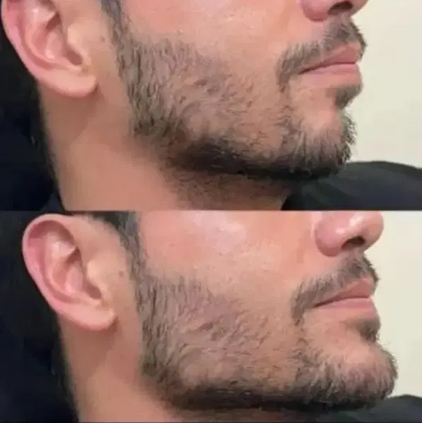ژل و بوتاکس|خدمات زیبایی و سلامت|اهواز, نادری|دیوار