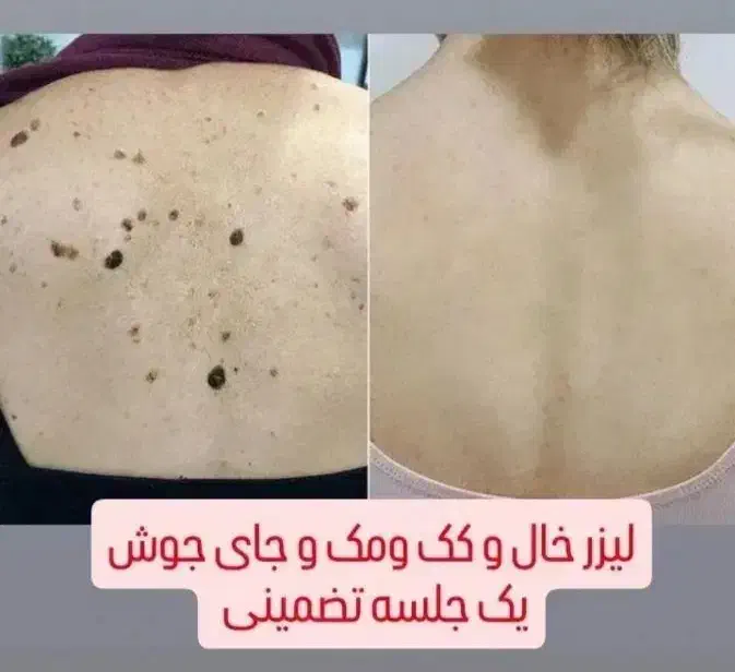 جشنوار یلدا درمان تضمینی کک ومک/لک/خال/فقط در1جلسه|خدمات آرایشگری و زیبایی|اصفهان, باغ زیار|دیوار