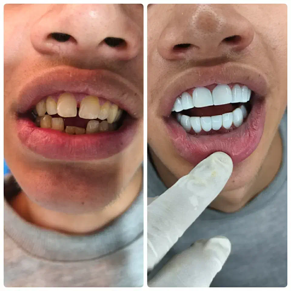 کامپوزیت دندان|خدمات آرایشگری و زیبایی|دورود, |دیوار