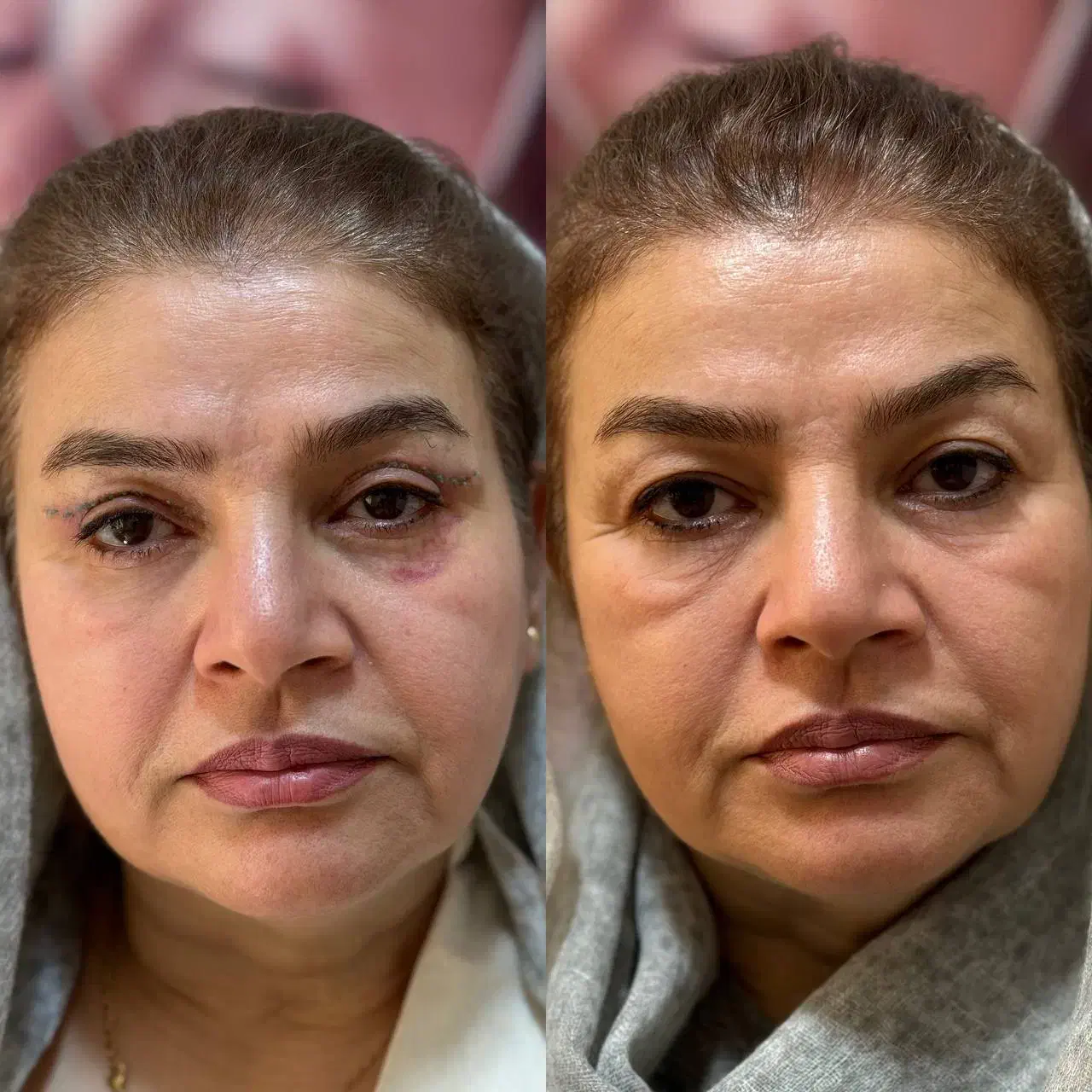 بلفاروپلاستی پلک بالا به مدت محدود فقط 8 میلیون|خدمات آرایشگری و زیبایی|بوکان, |دیوار