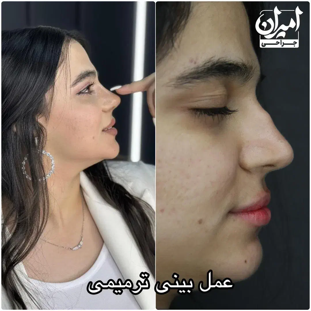 عمل بینی/جراحی بینی|خدمات آرایشگری و زیبایی|جهرم, |دیوار