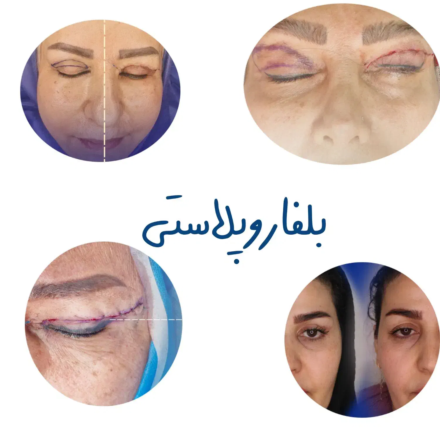 بلفاروپلاستی ، لیپو غبغب، تزریقات جوانساز|خدمات آرایشگری و زیبایی|تهران, دهم فروردین|دیوار