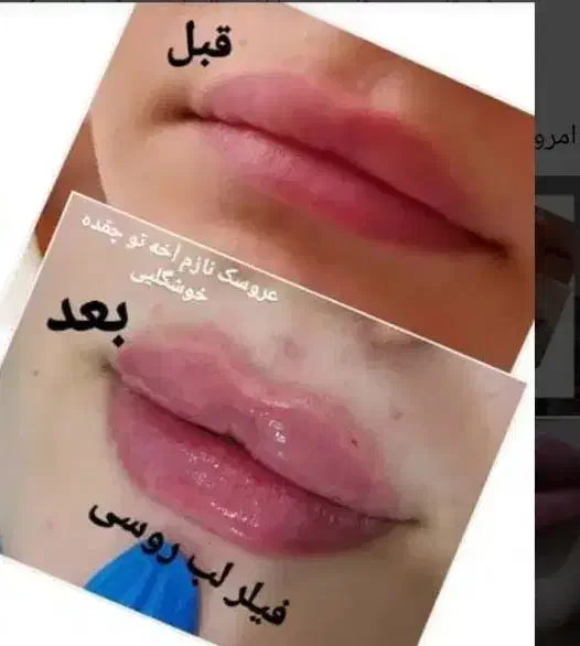 فیلر ژل لب و صورت و بوتاکس|خدمات آرایشگری و زیبایی|یاسوج, |دیوار