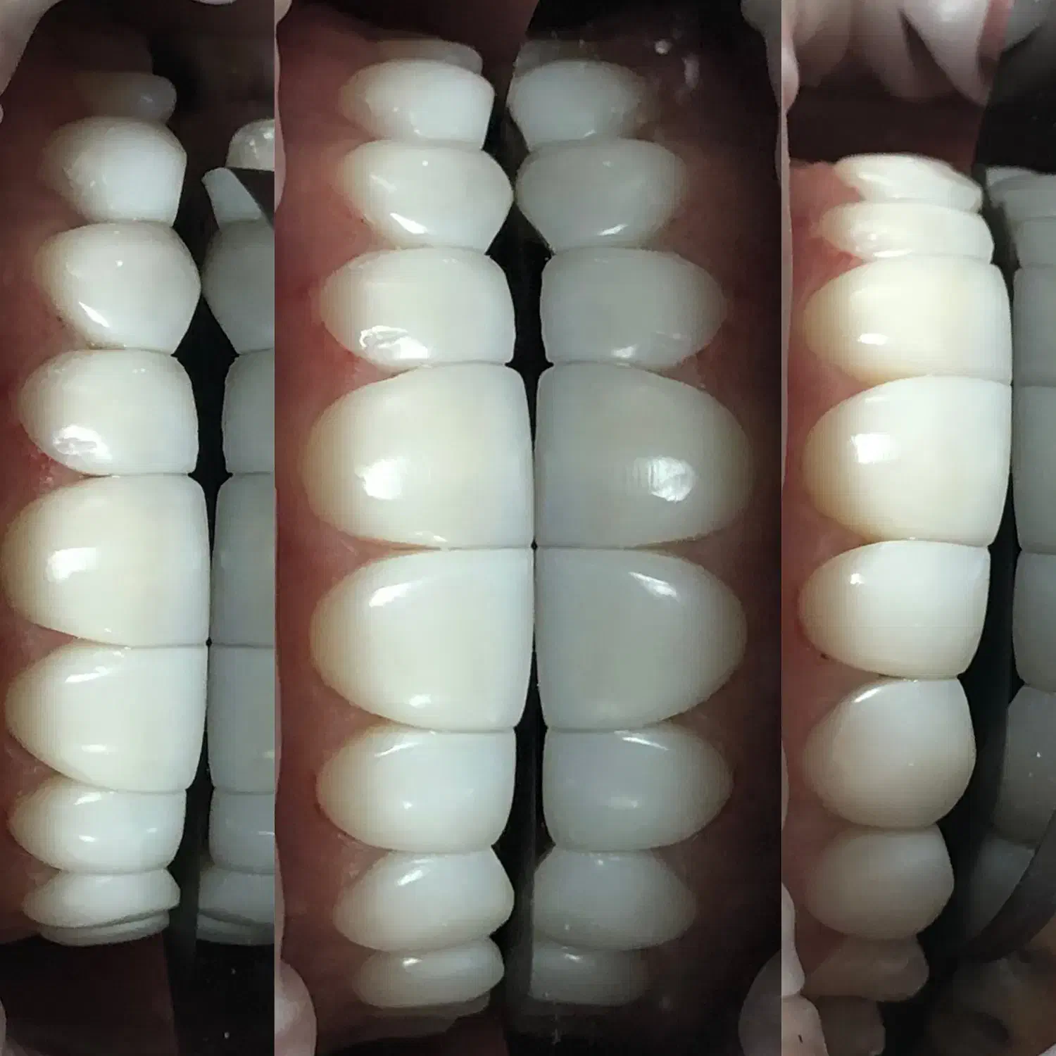 (زیبایی) ونییر کامپوزیت و لمینیت، بلیچینگ|خدمات آرایشگری و زیبایی|رشت, گلسار|دیوار