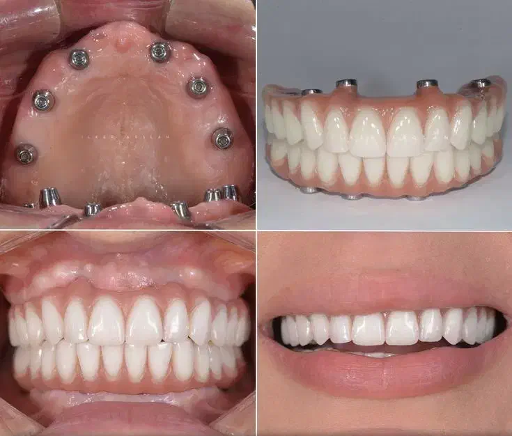 تمامی خدمات دندانپزشکی با بهترین کیفیت و اقساطی|خدمات آرایشگری و زیبایی|ماکو, |دیوار