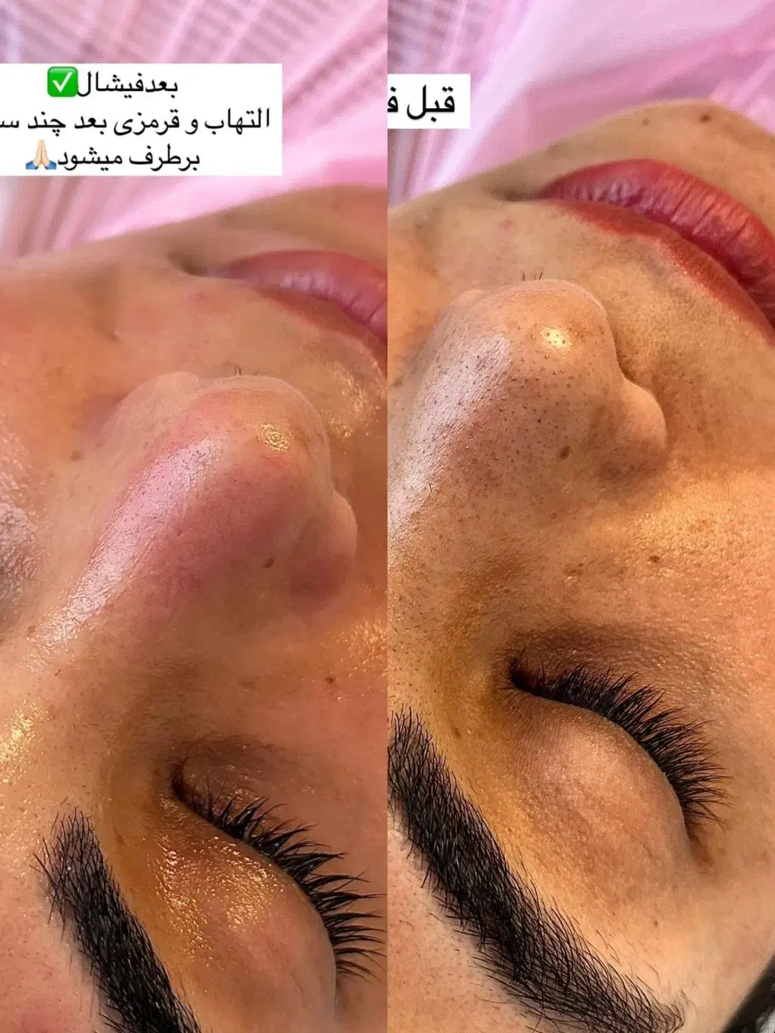 پاکسازی تخصصی پوست و لیفت ابرو روسی|خدمات آرایشگری و زیبایی|تنکابن, |دیوار