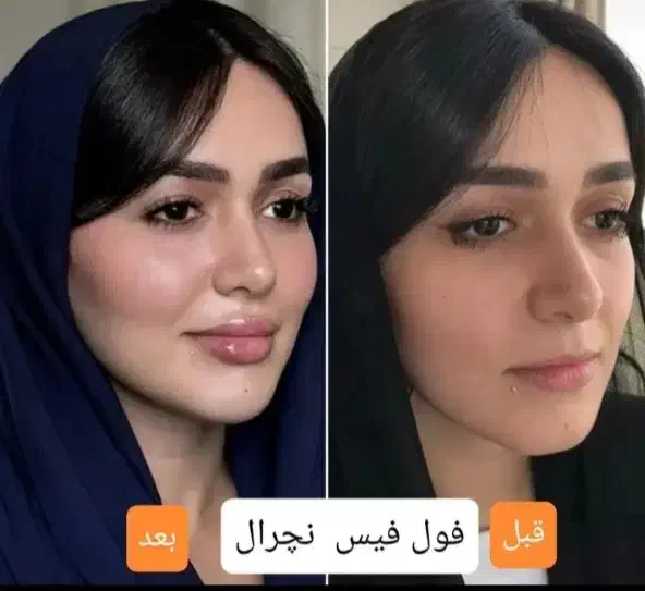 جشنواره پک مادلینگ +بوتاکس رایگان(فک لب گونه چانه)|خدمات آرایشگری و زیبایی|قم, زنبیل آباد|دیوار