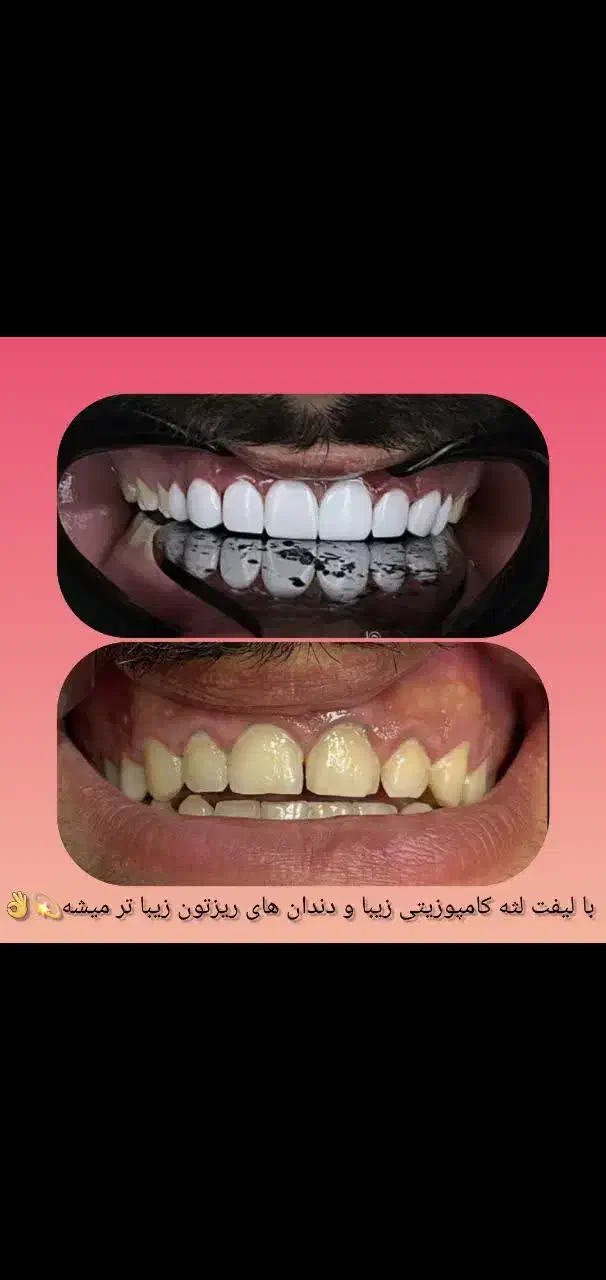 کامپوزیت فقط فکی ۱۶ تومن وآموزش  روز کامپوزیت|خدمات آرایشگری و زیبایی|تهران, شمشیری|دیوار