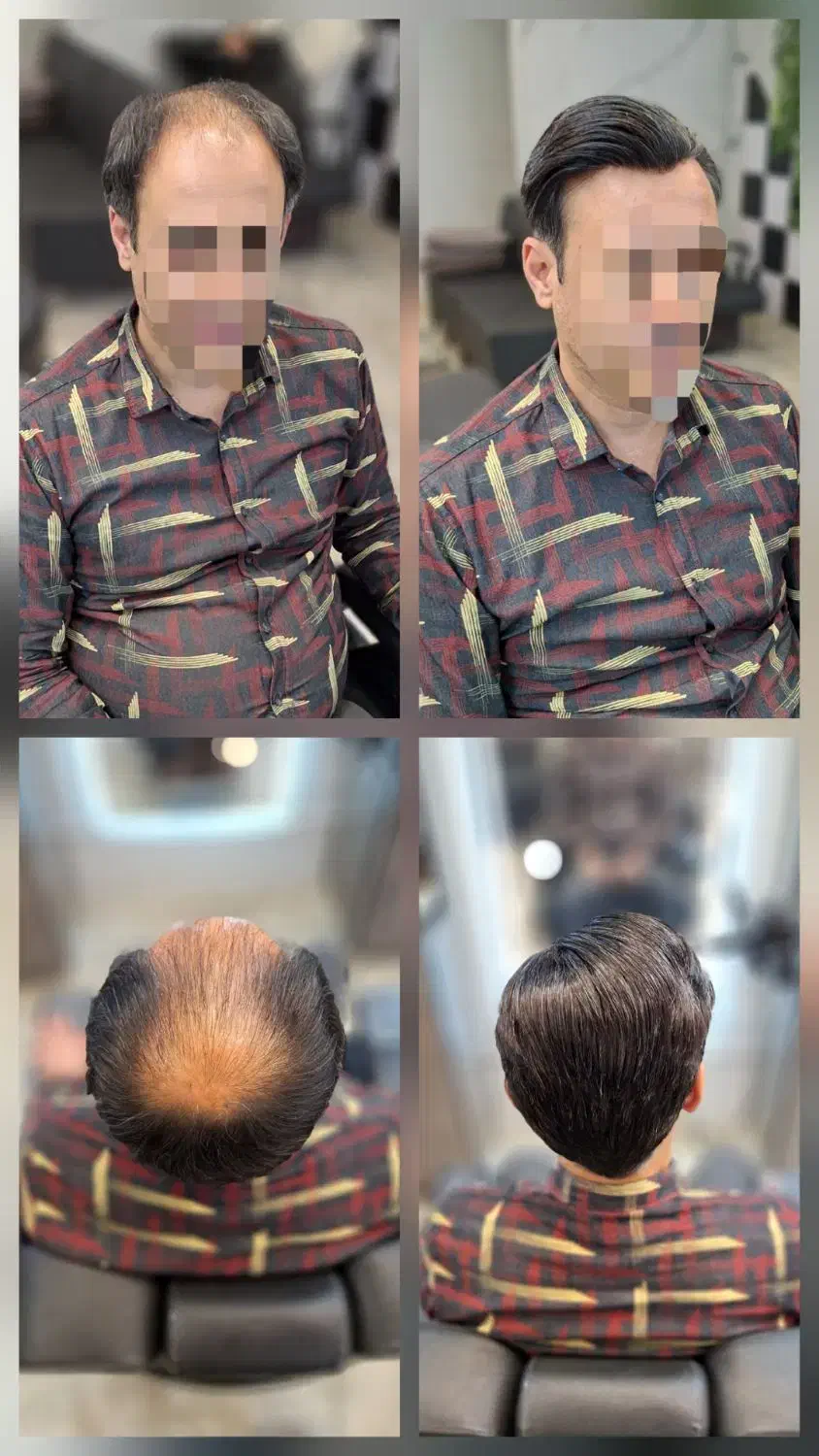 پروتز موی طبیعی و حرفه ای ویژه آقایان و بانوان|خدمات آرایشگری و زیبایی|کرمانشاه, |دیوار