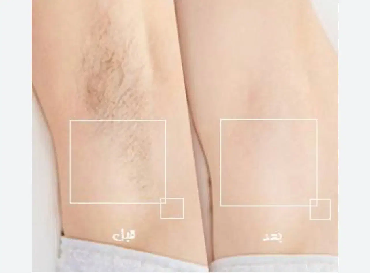 جشنواره لیزر حذف موهای زائد فول ۴۵۰|خدمات آرایشگری و زیبایی|ارومیه, |دیوار