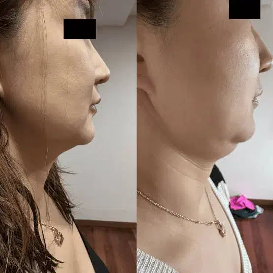 پی بی سرم کانتورینگ|خدمات آرایشگری و زیبایی|رشت, بلوار گیلان|دیوار