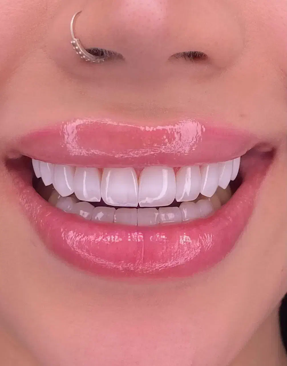 دندان کامپوزیت دندانپزشکی باهوش مصنوعی|خدمات آرایشگری و زیبایی|مشهد, دانشجو|دیوار