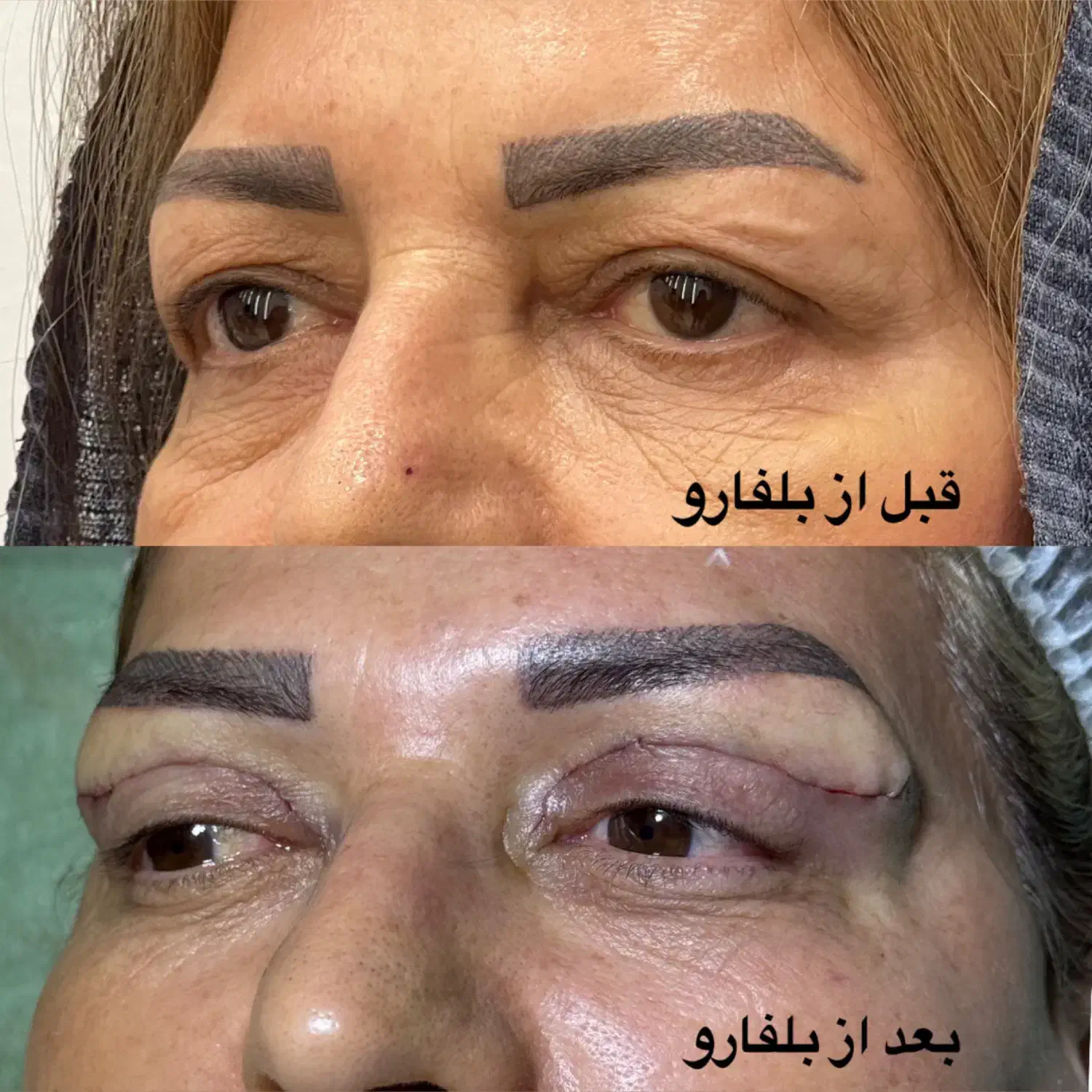 بلفارو روباهی در کلینیک مهرزاد|خدمات آرایشگری و زیبایی|تهران, جردن|دیوار