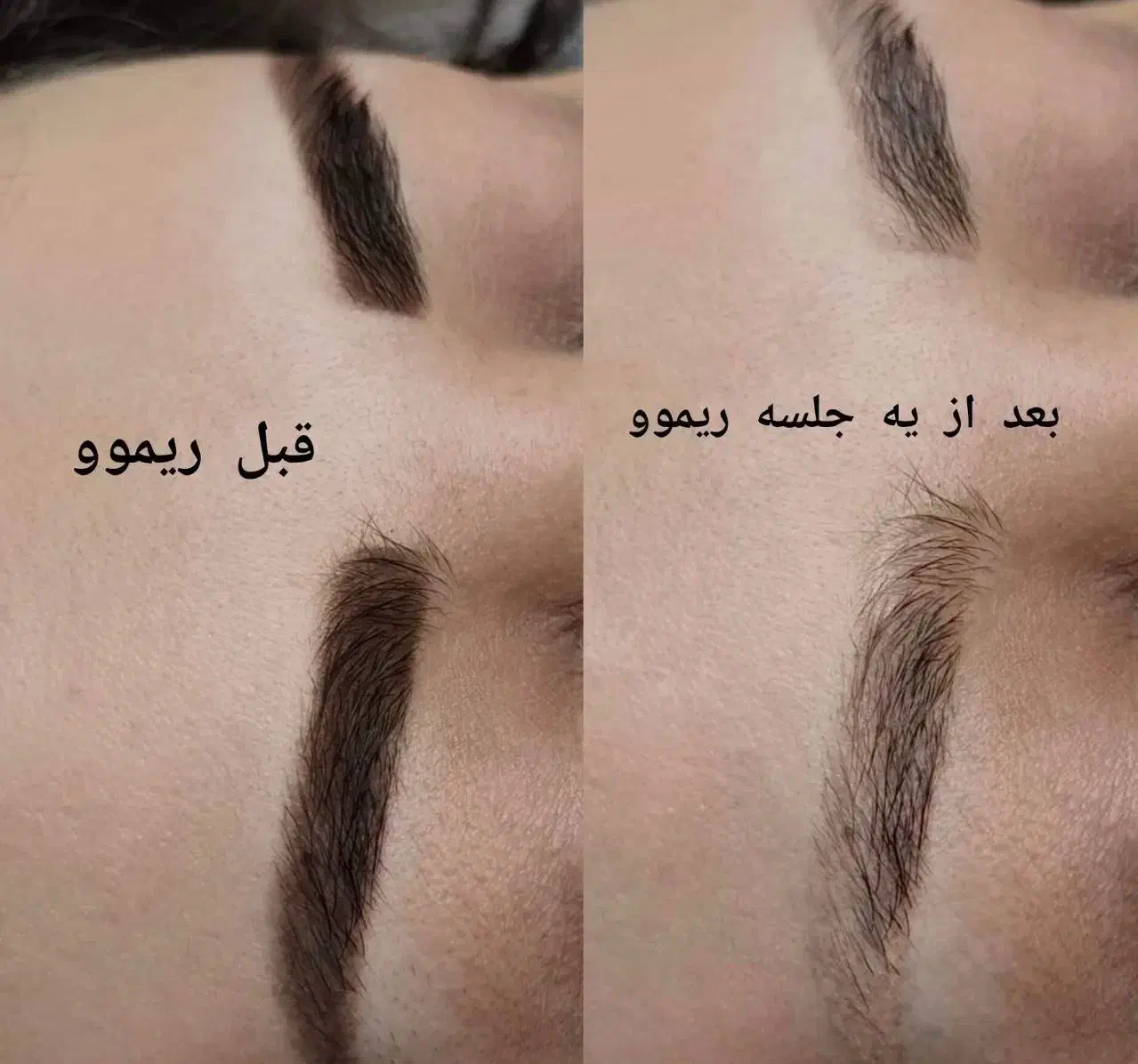 ریموو تتوهای قدیمی تک جلسه ای با آف ویژه|خدمات آرایشگری و زیبایی|شیراز, شهرک ولیعصر|دیوار