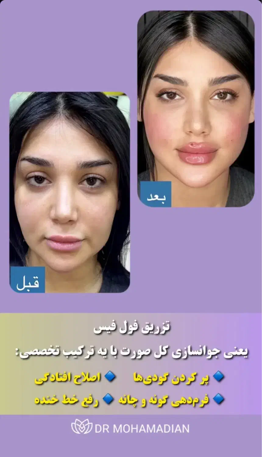 جشنواره فول فیس توسط پزشک متخصص|خدمات آرایشگری و زیبایی|تهران, ونک|دیوار