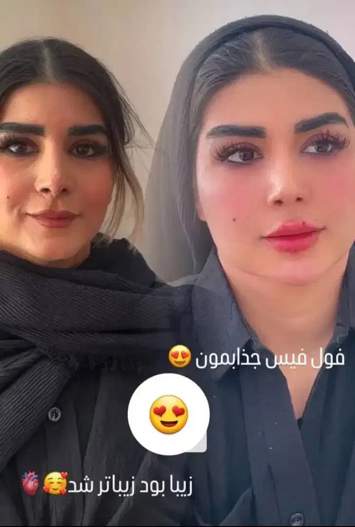 آف ویژه فیلر فول فسی  و مدلینگ صورت فقط ۳۹۰۰|خدمات آرایشگری و زیبایی|کرج, گوهردشت|دیوار