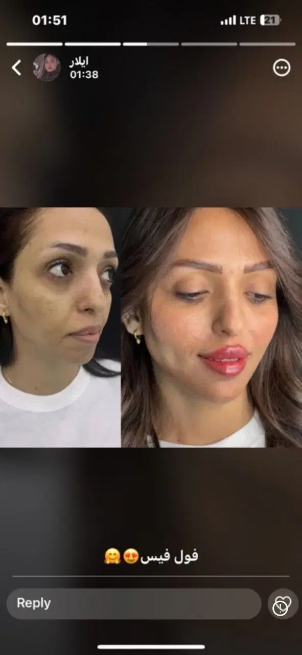 تزریقات ژل شروع قیمت از 750|خدمات آرایشگری و زیبایی|شیراز, شهرک مفتح|دیوار