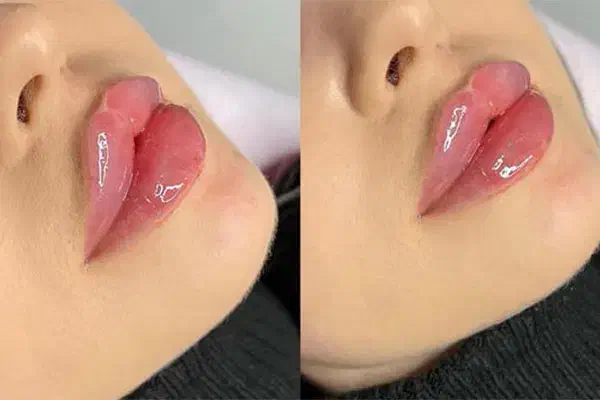 تخفیف تزریق ژل و مزوژل های جوانساز|خدمات آرایشگری و زیبایی|بوشهر, |دیوار