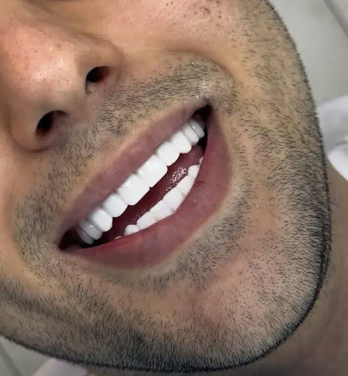 کامپوزیت دندان بابهترین موادفقط وفقط واحدی۹۹۹|خدمات آرایشگری و زیبایی|نیشابور, دارایی|دیوار