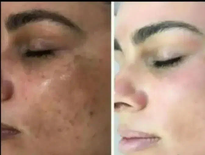 باضدلک اکسیس وای ۲۱ روزه دائمی درمان شو|آرایشی، بهداشتی، درمانی|اهواز, ۳۰ متری|دیوار