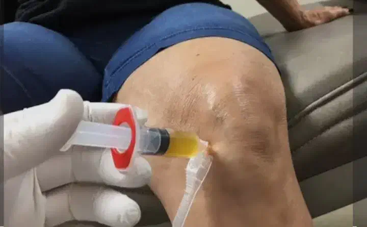 درمان آرتروز زانو/به روش پلاسما|خدمات آرایشگری و زیبایی|خرم‌آباد, |دیوار