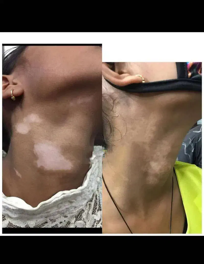 پیسی و پسوریازیس|خدمات آرایشگری و زیبایی|کرمانشاه, |دیوار