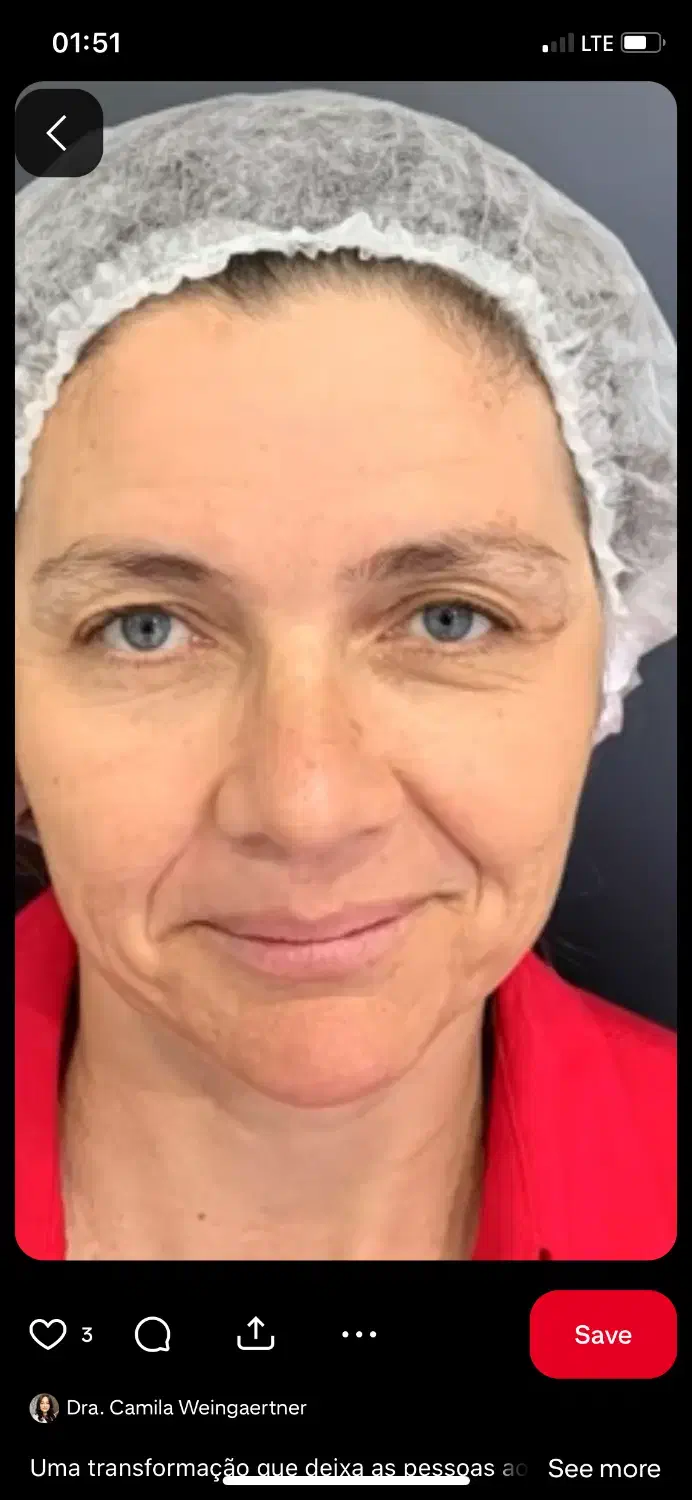 جشنواره تخفیف جراحی لیفت صورت|خدمات آرایشگری و زیبایی|کرج, مهرویلا جنوبی|دیوار