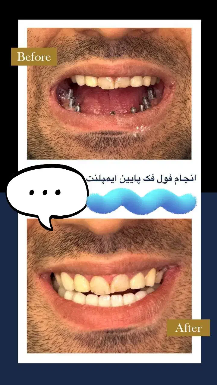 ایمپلنت تخصصی از ۷میلیون+ اوردنچر/ تخفیف تاآخرآذر|خدمات آرایشگری و زیبایی|اصفهان, جلفا|دیوار