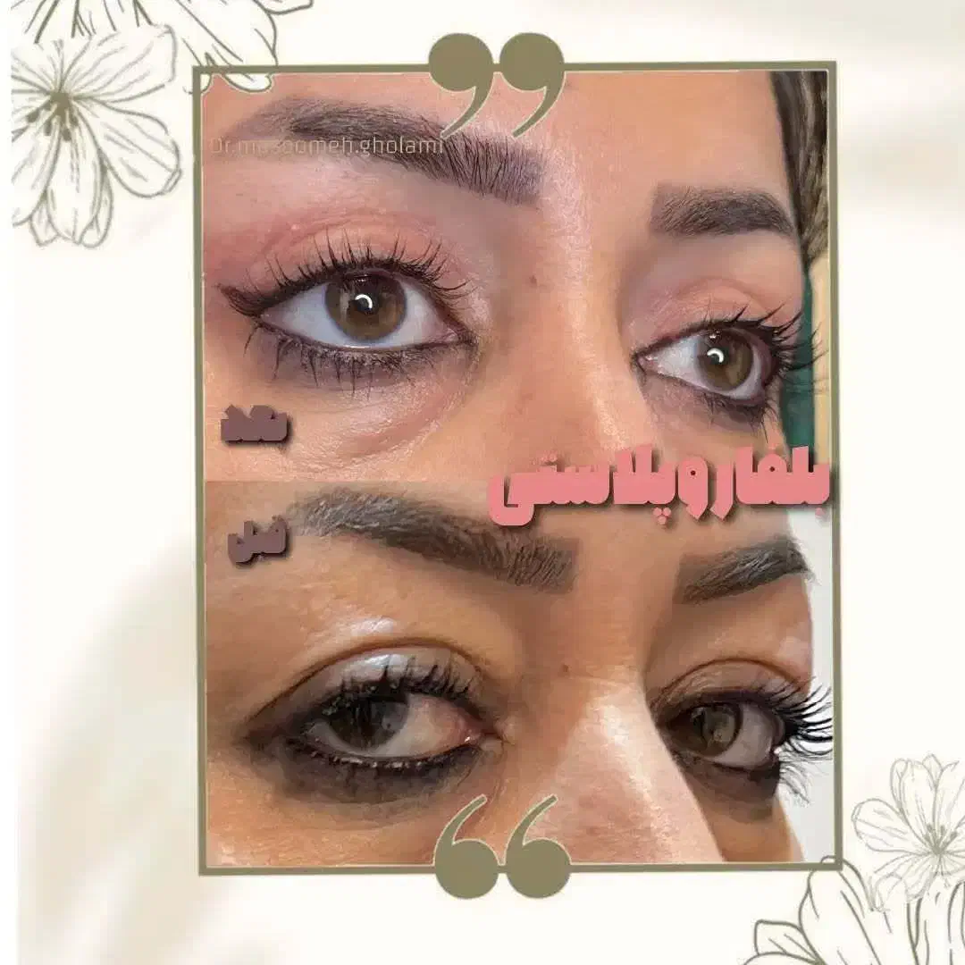 جشنواره تخفیف عمل تیپ پلاستی وبلفارو ابدو ساکشن|خدمات آرایشگری و زیبایی|مشهد, توس (بلوار توس)|دیوار