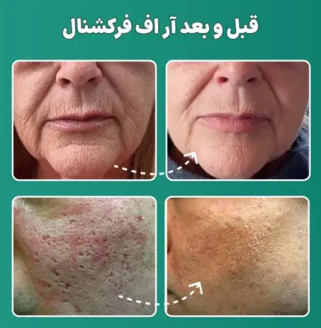 هایفوتراپی و آر اف ۷بعدی اولترا|خدمات آرایشگری و زیبایی|قم, زینبیه|دیوار