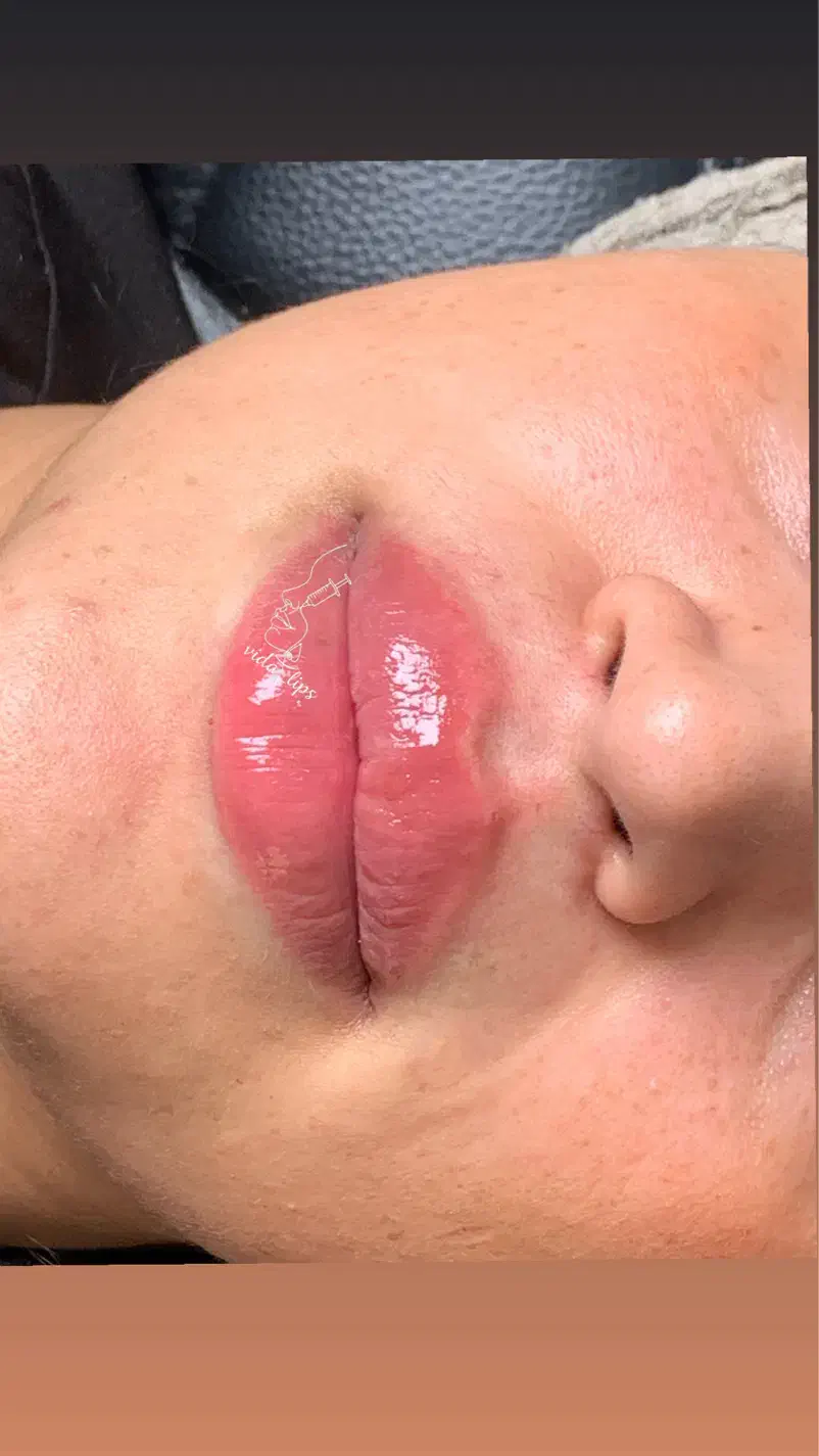 تزریق ژل سی سی ۴۰۰|خدمات آرایشگری و زیبایی|رباط‌کریم, نصیرشهر|دیوار