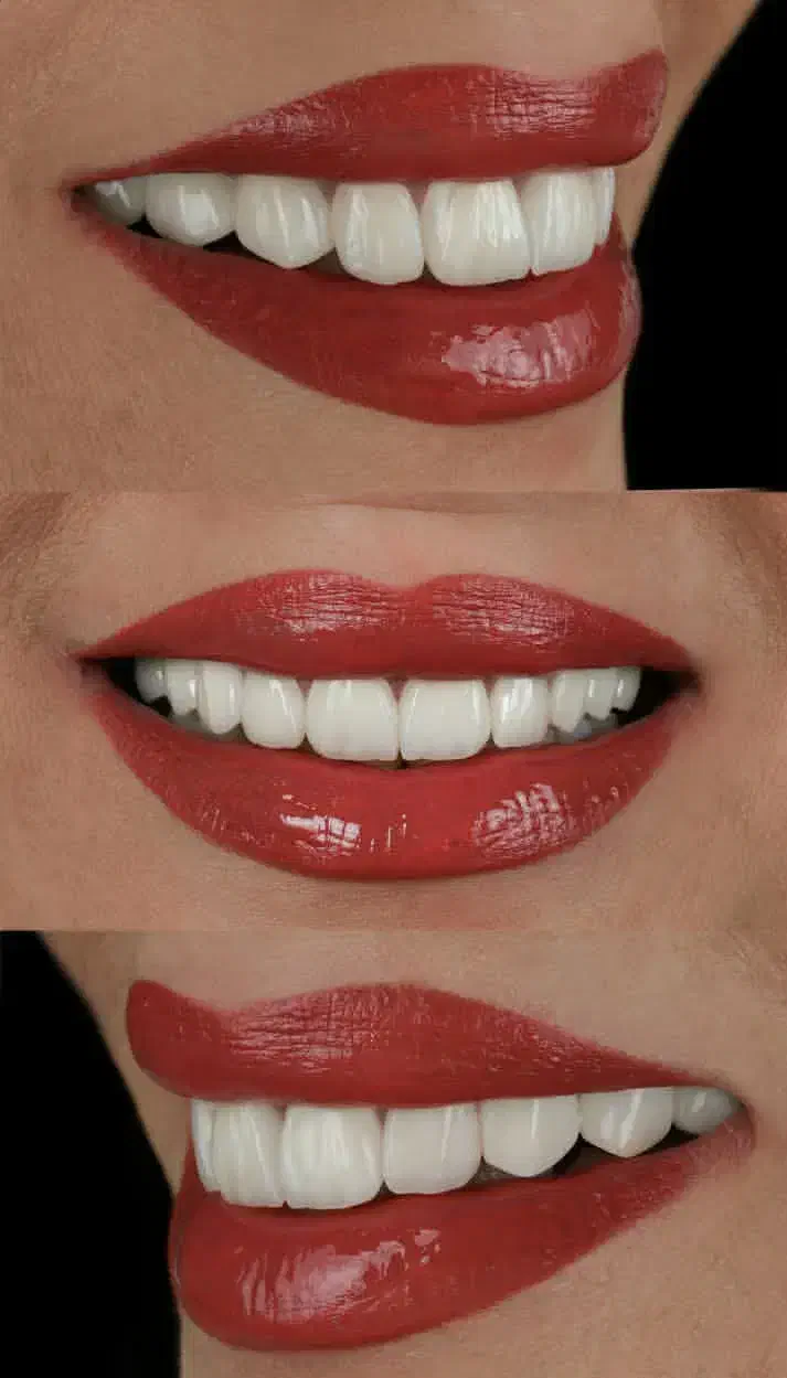 دندانپزشکی از دم قسط ایمپلنت کامپوزیت عصبکشی روکش|خدمات آرایشگری و زیبایی|خرمآباد, |دیوار