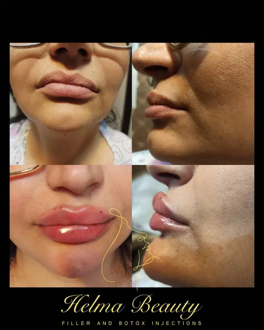 تزریق ژل و بوتاکس و انزیم و مزوجوانساز.|خدمات آرایشگری و زیبایی|پاکدشت, شهرک امام رضا|دیوار