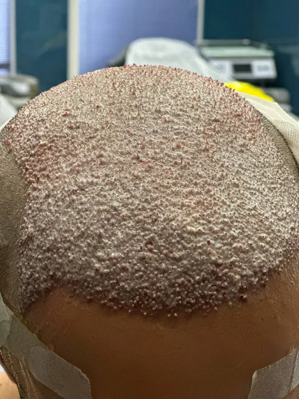 کاشت مو پر تراکم|خدمات آرایشگری و زیبایی|جهرم, |دیوار