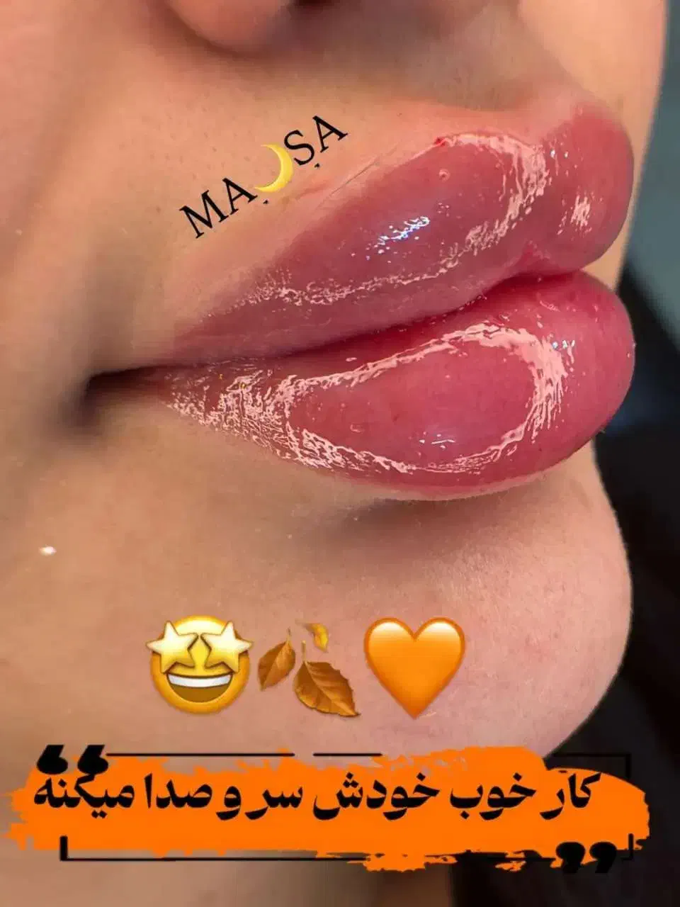 تزریق ژل و بوتاکس تضمینی|خدمات آرایشگری و زیبایی|قرچک, مهدیه|دیوار