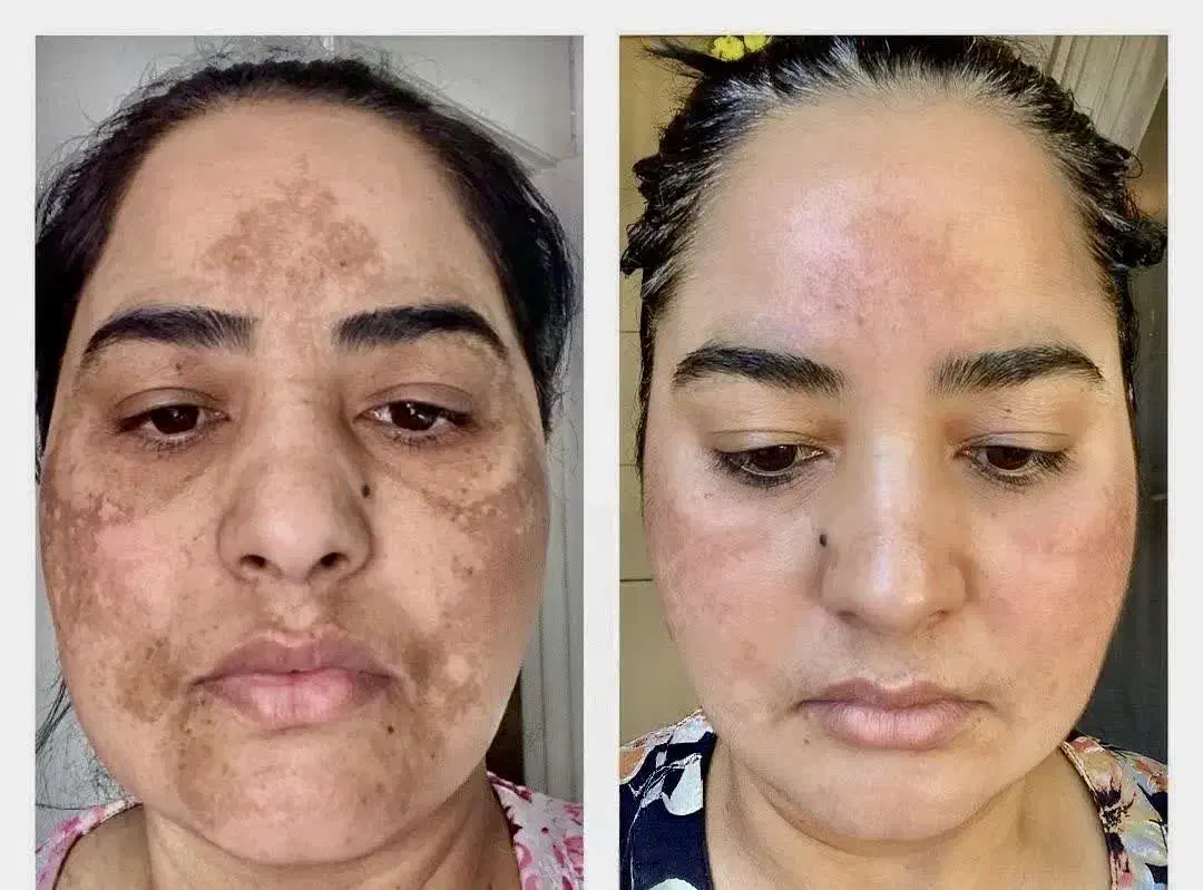 به مدل جهت انجام تکنیک آیینه سازی پوست|خدمات آرایشگری و زیبایی|ورامین, ورامین|دیوار