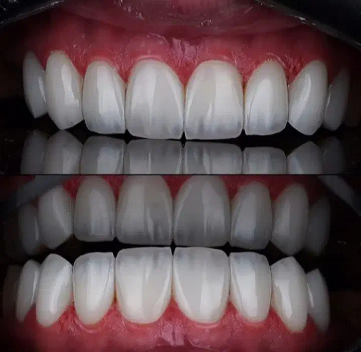 لمینیت،کامپوزیت،عصب کشی،ترمیم|خدمات آرایشگری و زیبایی|قم, عمار یاسر|دیوار