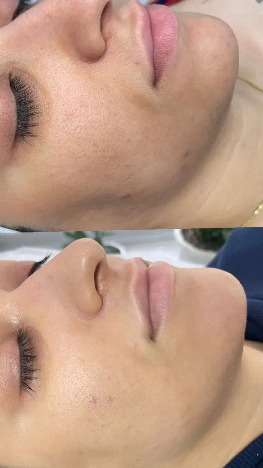 فیشیال تخصصی و درمانی پوست|خدمات آرایشگری و زیبایی|آمل, |دیوار