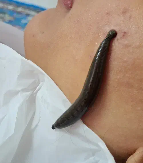 ریلکسیشن حجامت زالو|خدمات آرایشگری و زیبایی|شاهرود, |دیوار