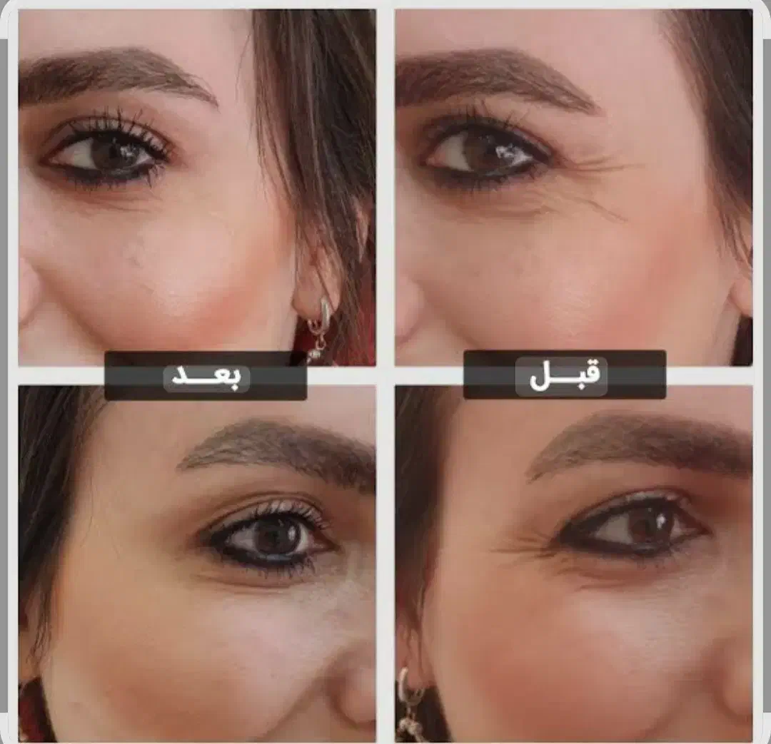 بوتاکس ژل صورت و بدن|خدمات آرایشگری و زیبایی|بیرجند, |دیوار