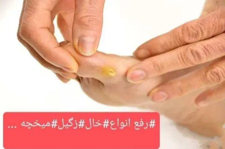 برداشت خال زگیل میخچه ختنه در مطب|خدمات آرایشگری و زیبایی|قم, هفت تیر|دیوار