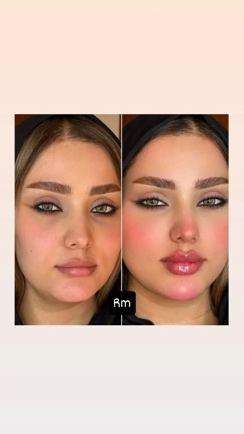 ۵۰ درصد تخفیف تزریق صورت سبک عربی هالیوودی لب روسی|خدمات آرایشگری و زیبایی|ری, دیلمان|دیوار