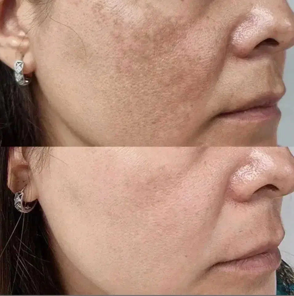 prp پی آر پی مو وصورت برای قطع ریزش و رویش مجدد مو|خدمات زیبایی و سلامت|اصفهان, خانه اصفهان|دیوار