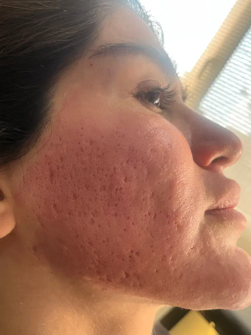 لیزر co2 تخفیف ویژه حذف اسکار،منافذوتیرگی ها مزو|خدمات آرایشگری و زیبایی|تهران, زعفرانیه|دیوار