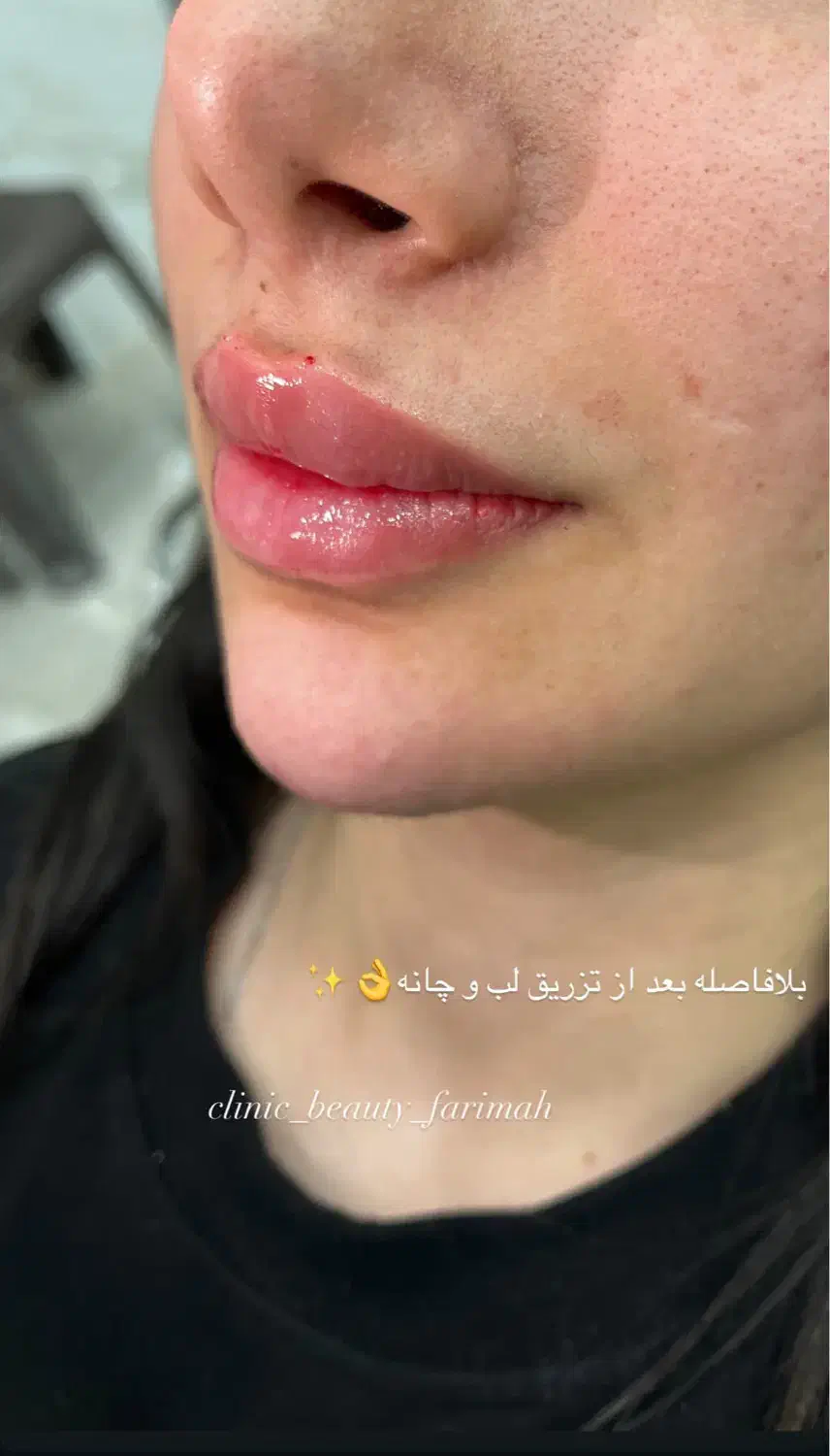 آف فیلر و بوتاکس فقطط۵۸۰|خدمات آرایشگری و زیبایی|ایذه, |دیوار