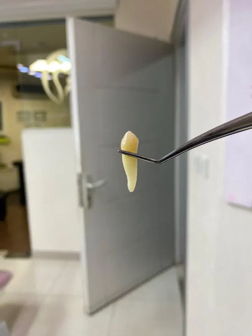 فروش دندان های خلفی4.5سالم|پزشکی|رشت, سعدی (تختی)|دیوار