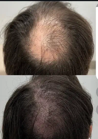 میکرواسکالپ تخصصی با جدیدترین متدvip|خدمات آرایشگری و زیبایی|مشهد, گوهرشاد|دیوار