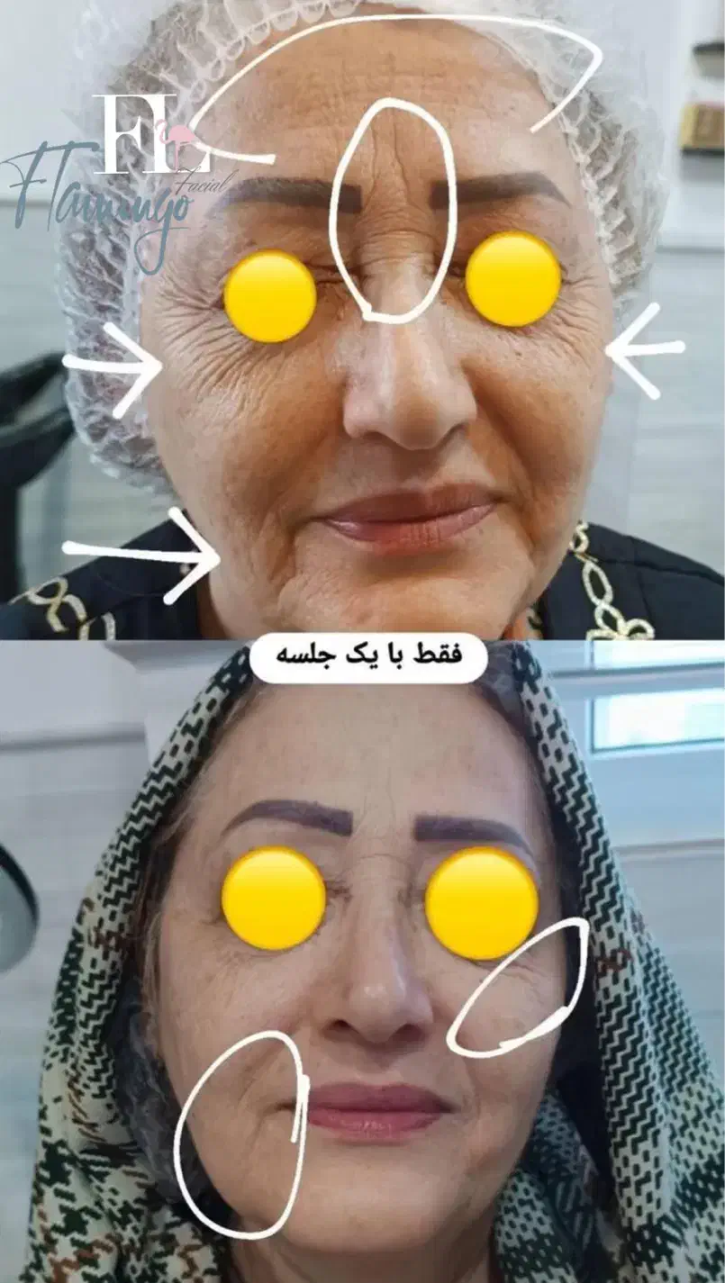 فیشال‌درمطب/درمان‌جوش‌وخشکی/هایفو|خدمات آرایشگری و زیبایی|قم, دورشهر|دیوار