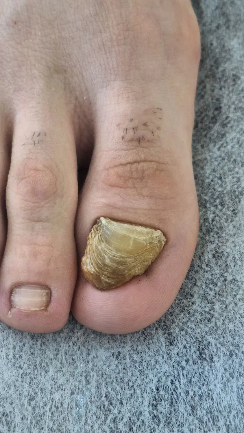 درمان ناخن تو گوشت رفته و قارچ گرفته|آرایشی، بهداشتی، درمانی|ارومیه, |دیوار