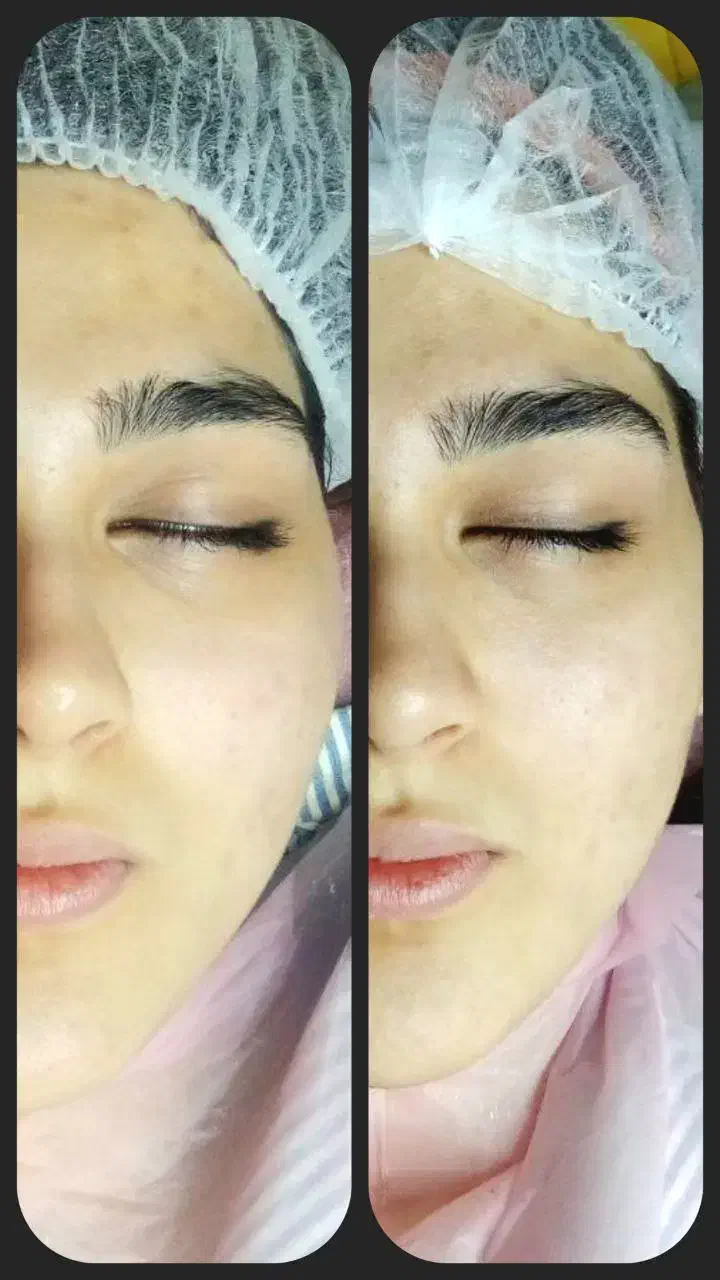 فیشال تخصصی پوست با هدیه بمناسبت افتتاحیه|خدمات آرایشگری و زیبایی|مشهد, هنرستان|دیوار